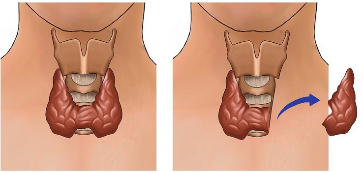 Гемитиреоидэктомия г. Ханты-Мансийск