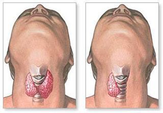 Гемитиреоидэктомия г. Ханты-Мансийск