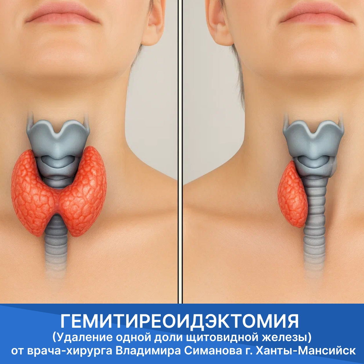 Гемитиреоидэктомия г. Ханты-Мансийск