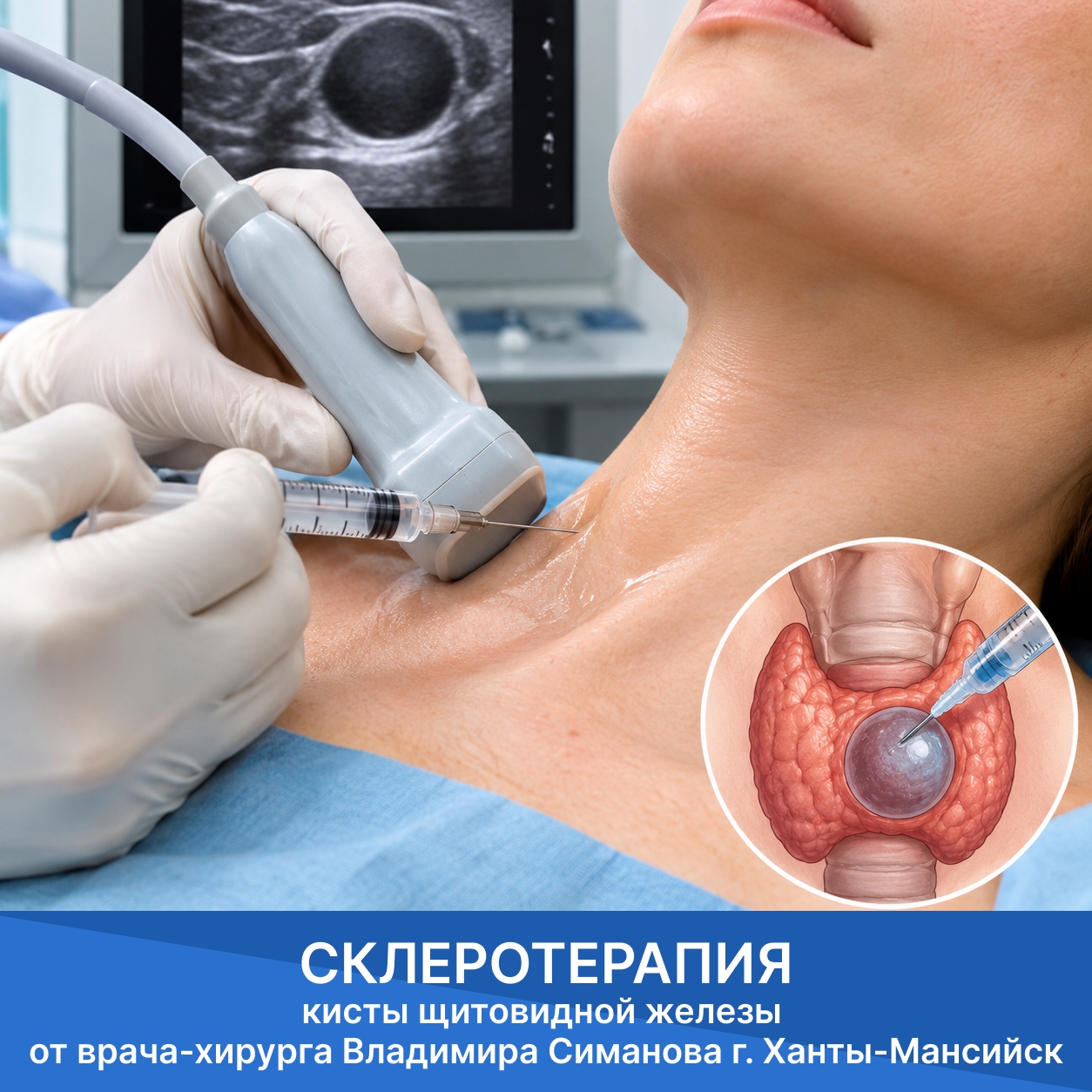 Cклеротерапия кисты щитовидной железы г. Ханты-Мансийск