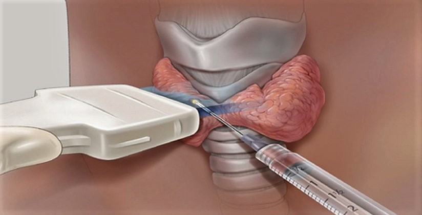 Пункционная биопсия щитовидной железы г. Ханты-Мансийск